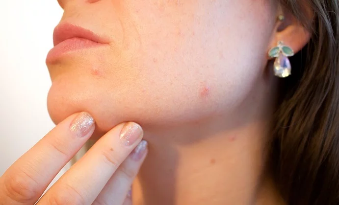 Is Acne Preventable Using Apple Cider Vinegar?